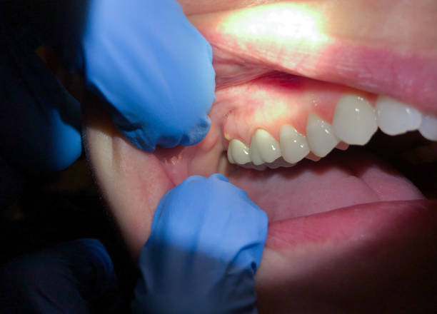 Best Chipped Tooth Repair Near Me  in Ackerman, MS
